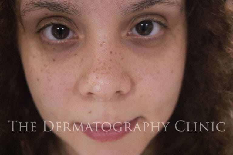 Close-up of face showing natural skin before freckle tattoo treatment, with minimal visible freckles.
