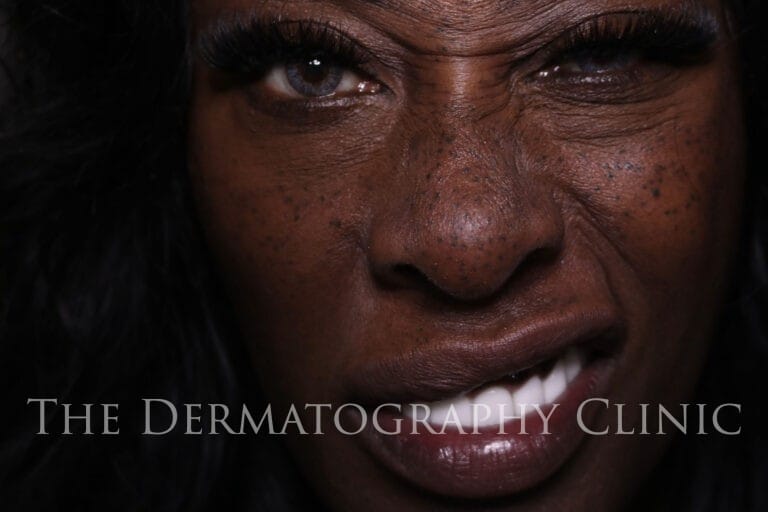 Freckle tattoo treatment on dark skin, highlighting cosmetic tattoo freckles across nose and cheeks.