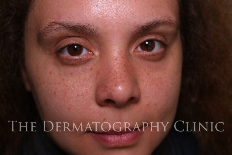 Close-up after freckle tattoo session, showing semi-permanent freckles designed for a natural sun-kissed look.