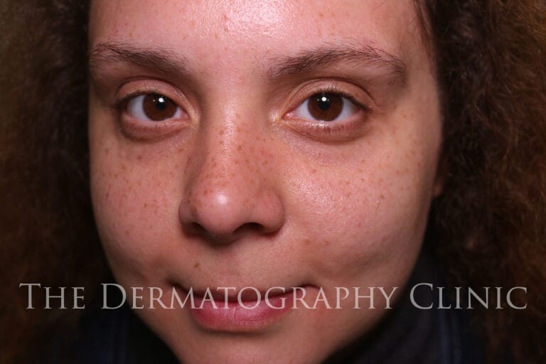 Healed freckle tattoo results on medium-toned skin, showing soft natural-looking freckles across face.