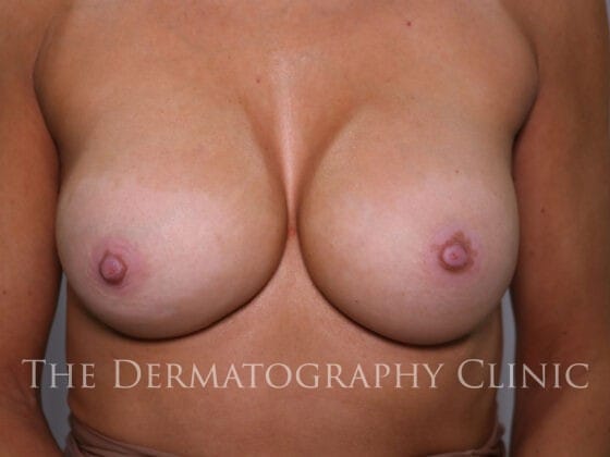 Before Areola Camouflage Tattoo