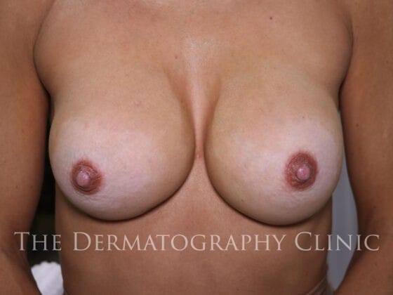 Photograph of Areola Camouflage Tattoo