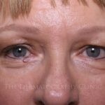 Healed micropigmentation on woman with alopecia, showing fully restored eyeliner and natural-looking eyebrows