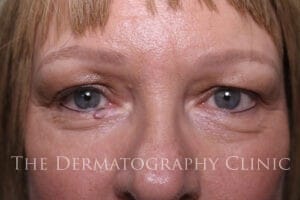 Healed results of micropigmentation for alopecia on woman’s face, with restored lash line and natural-looking eyebrows after alopecia-related hair loss.