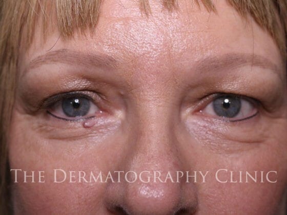 Healed results of micropigmentation for alopecia on woman’s face, with restored lash line and natural-looking eyebrows after alopecia-related hair loss.