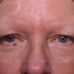 Close-up of woman’s face before micropigmentation, showing absent eyebrows and lashes due to alopecia