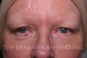 Close-up of woman’s face before receiving micropigmentation for alopecia, showing no eyebrows and lash loss due to alopecia.