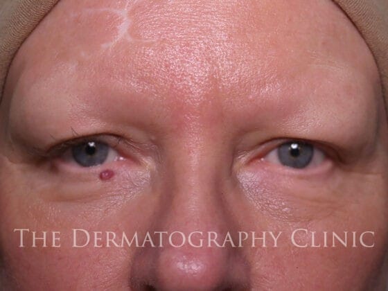 Close-up of woman’s face before receiving micropigmentation for alopecia, showing no eyebrows and lash loss due to alopecia.