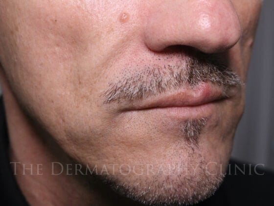 This client’s deep nasolabial folds have been gently lifted, preserving a natural masculine appearance and subtle confidence.