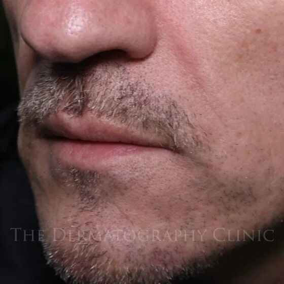 Side profile of man with nasolabial folds treated with needle-free filler