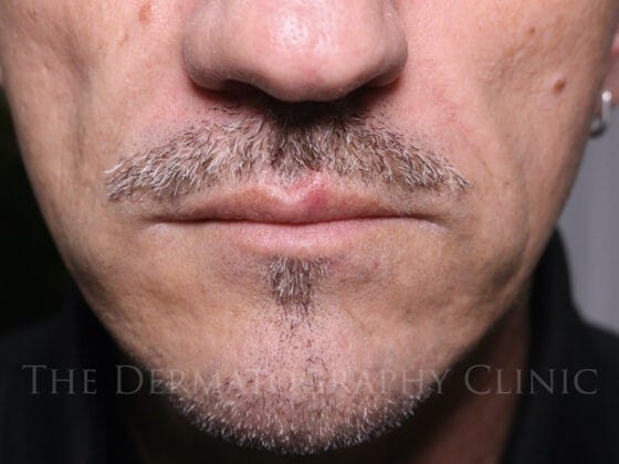 Before and after male client with deep nasolabial folds lifted using needle-free filler