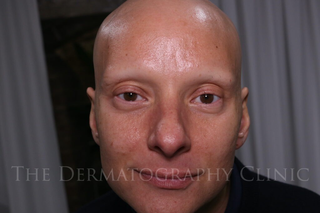 male client’s face before micropigmentation, showing absent eyebrows due to alopecia