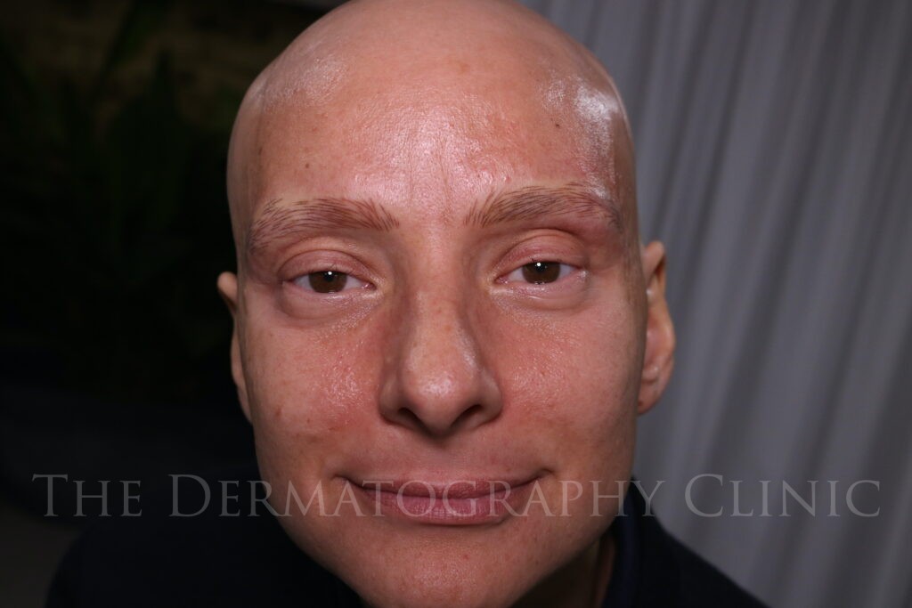 Micropigmentation on male client with alopecia, showing fully restored hair stroke eyebrows