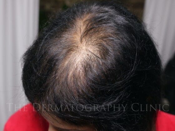 Female client with androgenetic alopecia before scalp micropigmentation treatment, showing visible scalp and reduced hair density.