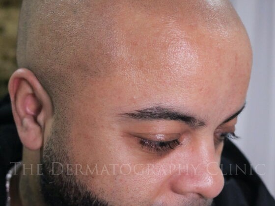 Healed scalp micropigmentation result showing natural density and blending following long-term healing