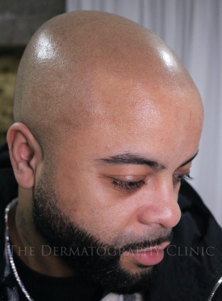 Healed scalp micropigmentation result showing natural density and blending following long-term healing
