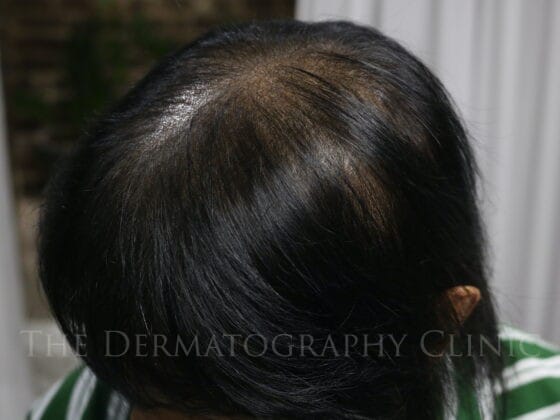 Female client with androgenetic alopecia after fully healed scalp micropigmentation treatment, showing the appearance of increased hair density and reduced scalp visibility.
