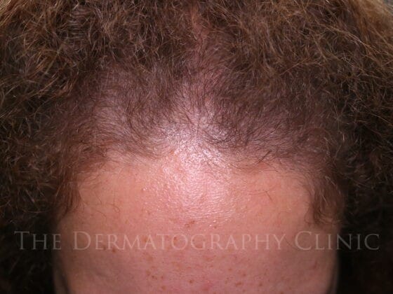 Female client showing frontal diffuse thinning with reduced density across the frontal hairline before scalp micropigmentation