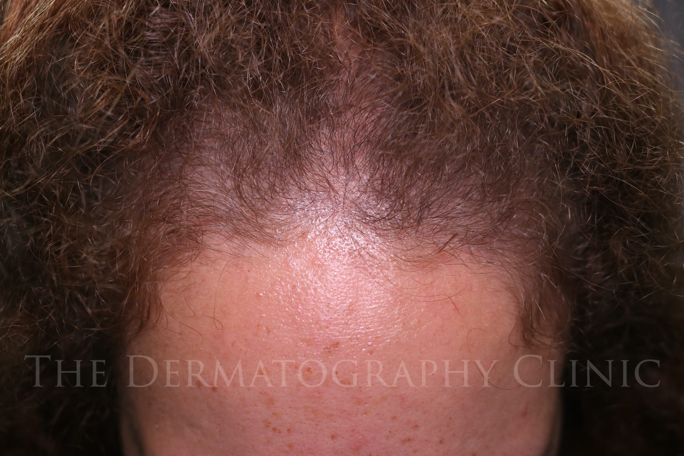 Female client showing frontal diffuse thinning with reduced density across the frontal hairline before scalp micropigmentation