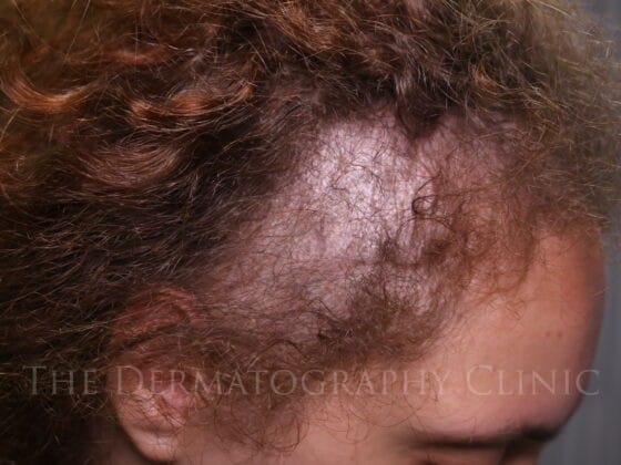 Female client right profile showing temple thinning and reduced density before scalp micropigmentation