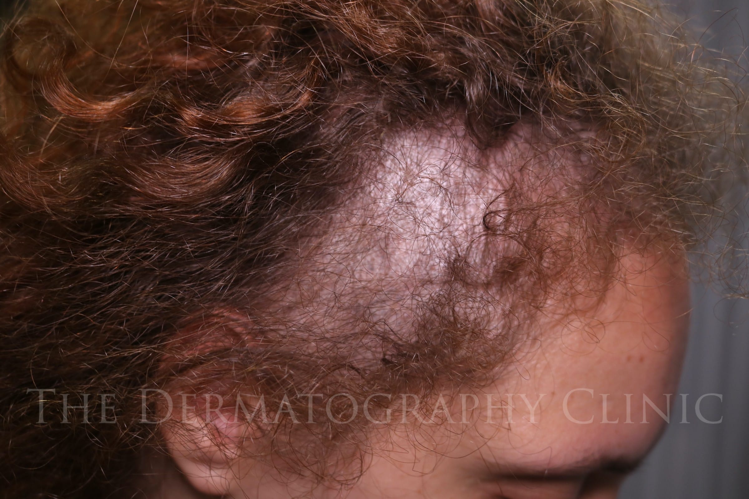 Female client right profile showing temple thinning and reduced density before scalp micropigmentation