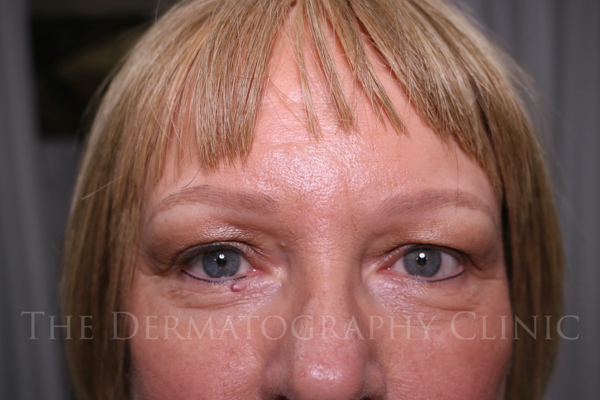 Healed micropigmentation on woman with alopecia, showing fully restored eyeliner and natural-looking eyebrows