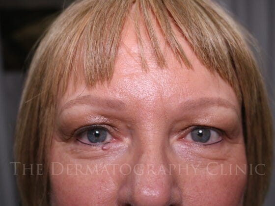 Showing hair-stroke eyebrow micropigmentation for female client with Alopecia showing she has restored natural eyebrows - healed result.