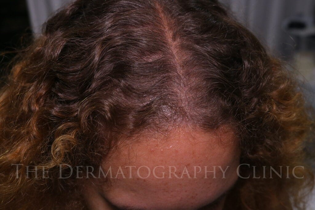 Post treatment image showing top view healed results scalp micropigmentation for frontal and temple thinning in female client.