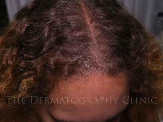 Post treatment image showing top view healed results scalp micropigmentation for frontal and temple thinning in female client.