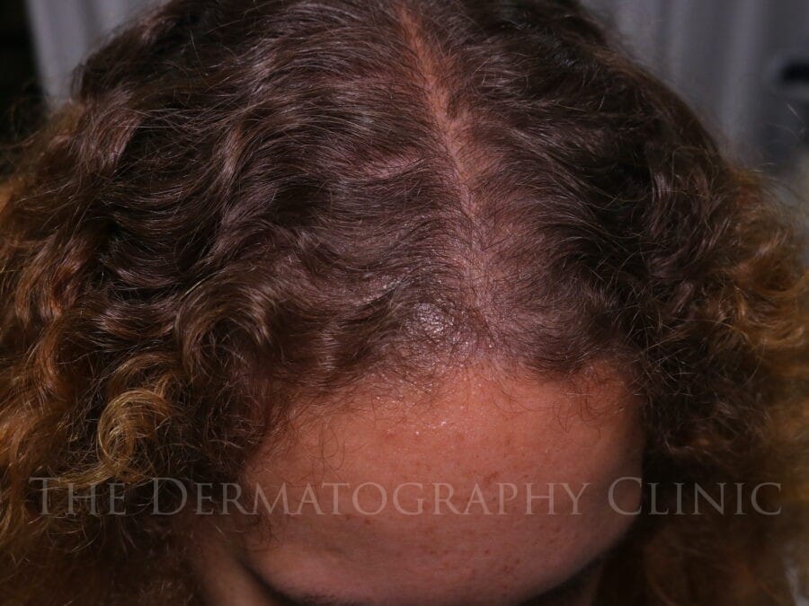 Post treatment image showing top view healed results scalp micropigmentation for frontal and temple thinning in female client.