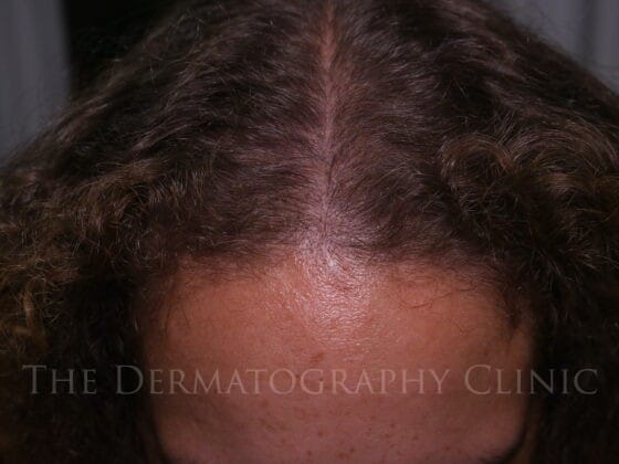 Healed scalp micropigmentation for female client showing improved frontal density with subtle natural blending