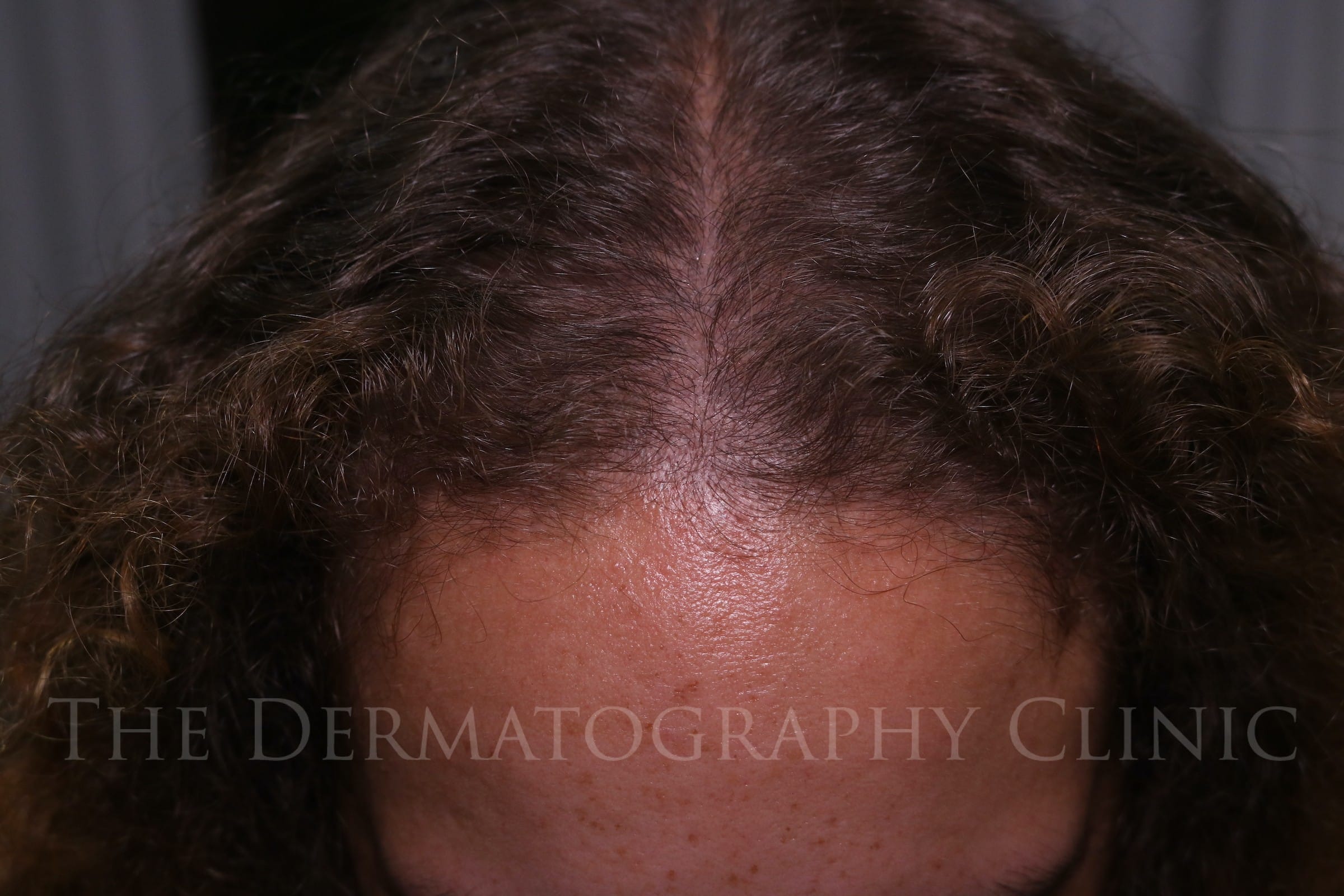 Healed scalp micropigmentation for female client showing improved frontal density with subtle natural blending