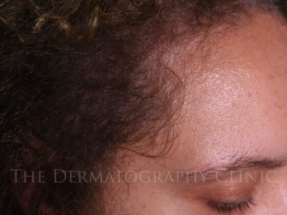 Healed scalp micropigmentation result showing improved right side density and natural blending in female client