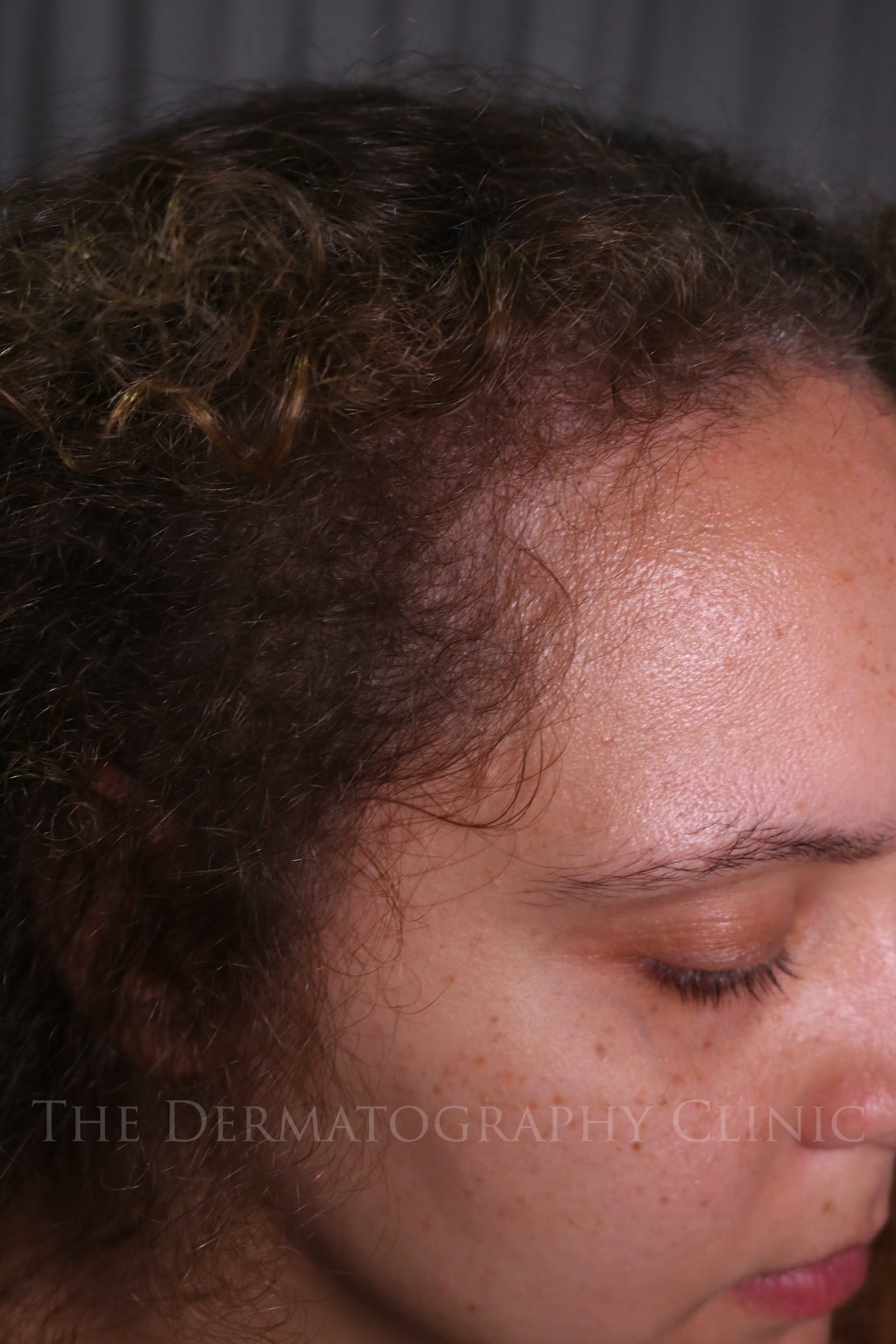Healed scalp micropigmentation result showing improved right side density and natural blending in female client
